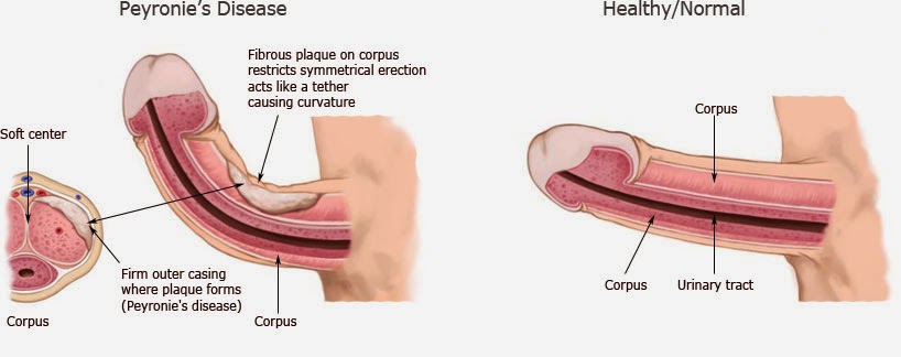st john us virgin islanda what exercise can i do to straighten a bent penis